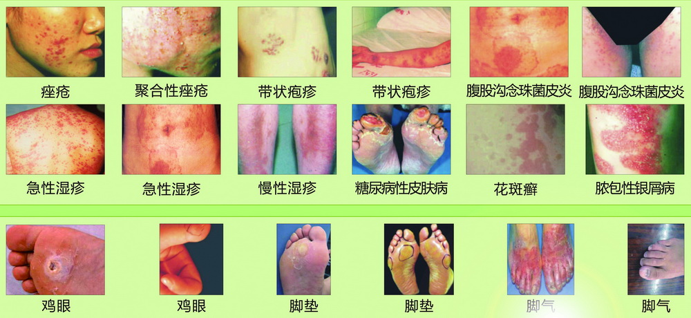 皮膚癬、濕疹、腳氣、腳墊、雞眼